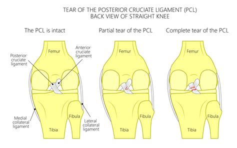 testing acl tear|high grade acl tear treatment.